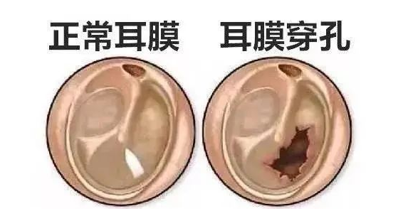 【听力科普】从零开始的日常听力保健(中耳篇)(图3) 【听力科普】从零开始的日常听力保健(中耳篇)(图3)
